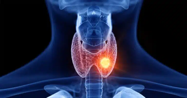 Hashimoto's Thyroiditis